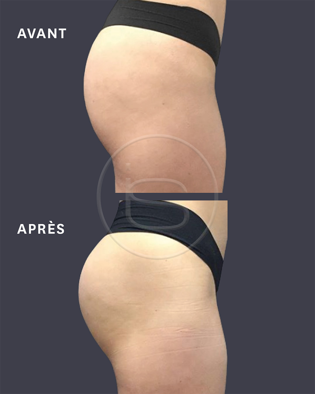 Avant / Après Emsculpt Neo — Fesses