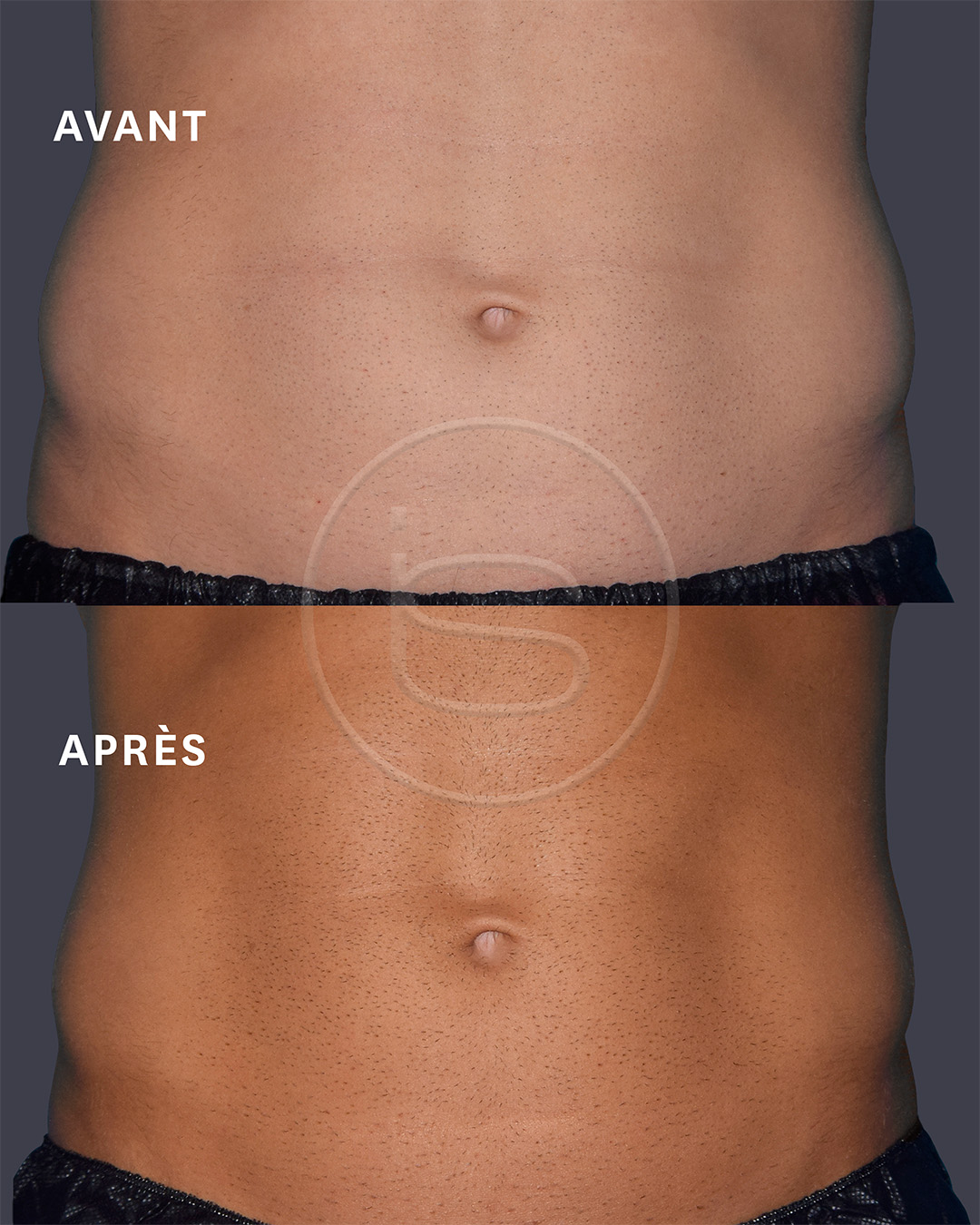 Avant / Après Emsculpt Neo — Abdomen