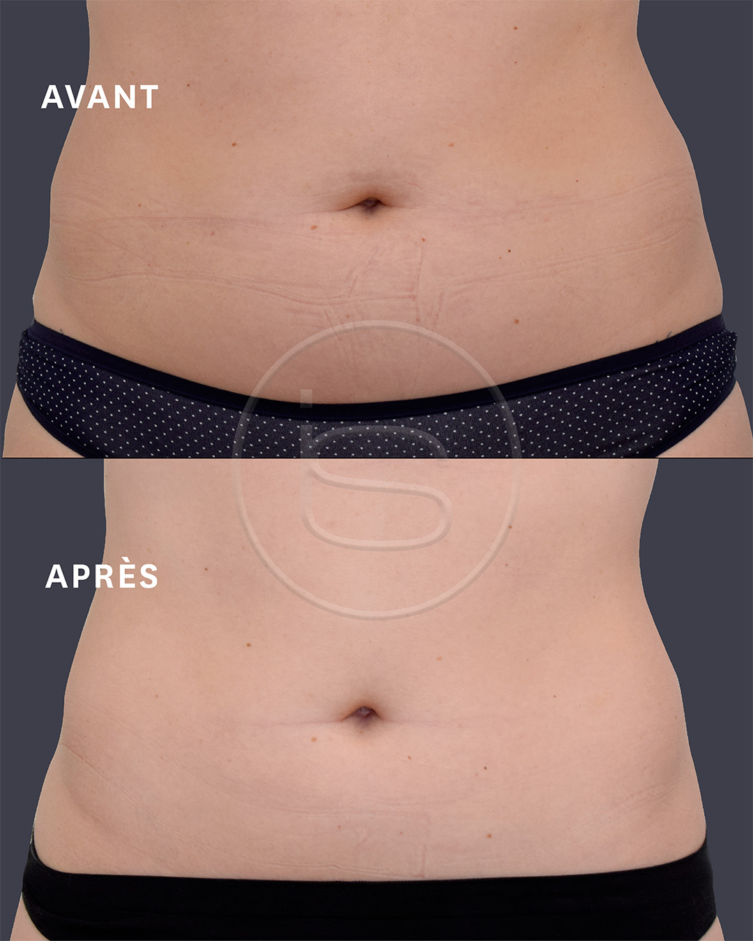 Avant / Après Emsculpt Neo — Abdomen post-partum