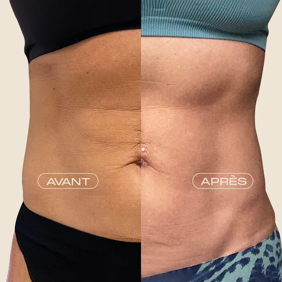 Avant / Après Emsculpt Neo — Abdomen